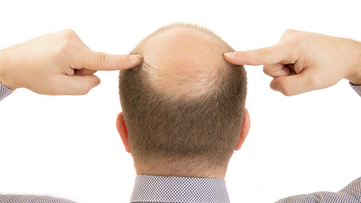 What is hair loss
