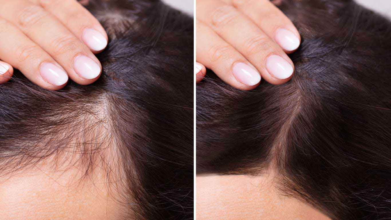 Hair Shedding Vs Hair Loss How To Differentiate Between The Two Superhairpiecesca 5670